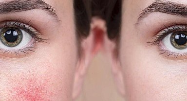 Ciltte yaşayan görünmez tehdit: Demodeks akarlarına dikkat