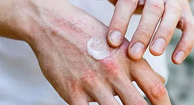 El ve dudak kuruluğunu gidermenin doğal yolları